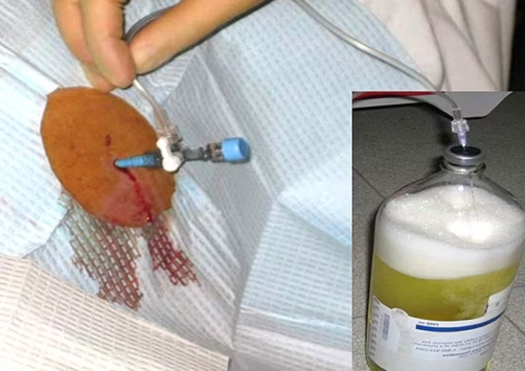 Ascitic Fluid Paracentesis